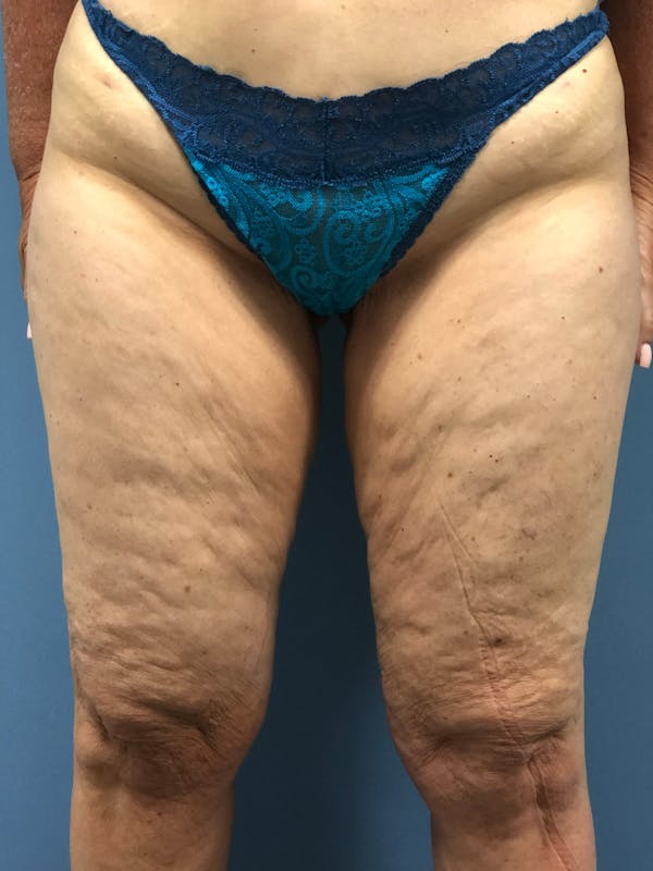 Thigh Lift Before & After Gallery - Patient 153156251 - Image 1