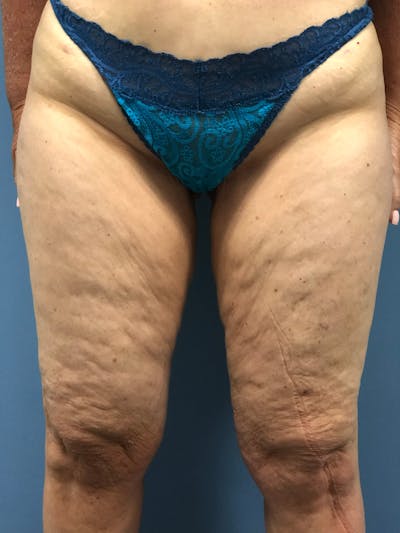 Thigh Lift Before & After Gallery - Patient 153156251 - Image 1