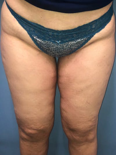 Thigh Lift Before & After Gallery - Patient 153156251 - Image 2