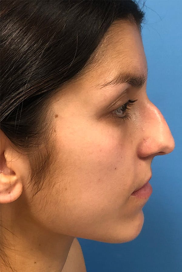 Rhinoplasty Before & After Gallery - Patient 116328 - Image 1