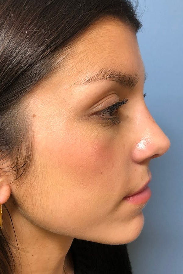 Rhinoplasty Before & After Gallery - Patient 116328 - Image 2