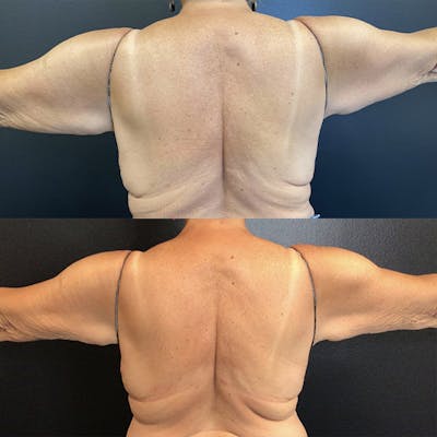 BodyTite Before & After Gallery - Patient 122606659 - Image 1