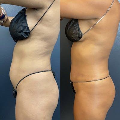 BodyTite Before & After Gallery - Patient 122606660 - Image 1