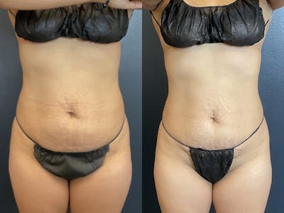 EMSCULPT Before & After Gallery - Patient 122606680 - Image 1