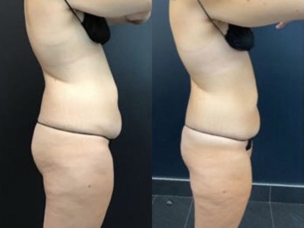 EMSCULPT Before & After Gallery - Patient 122606681 - Image 1