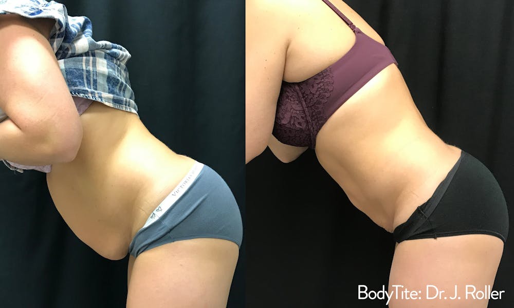 BodyTite Before & After Gallery - Patient 148257640 - Image 1
