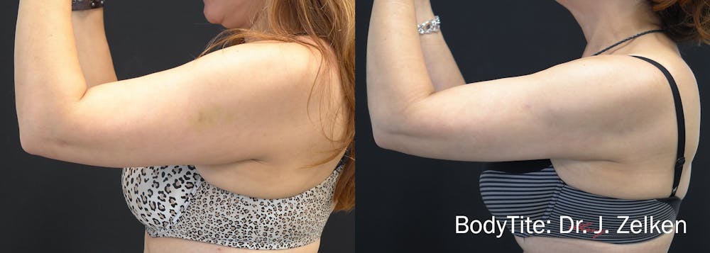 BodyTite Before & After Gallery - Patient 148257648 - Image 1