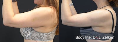 BodyTite Before & After Gallery - Patient 148257648 - Image 1