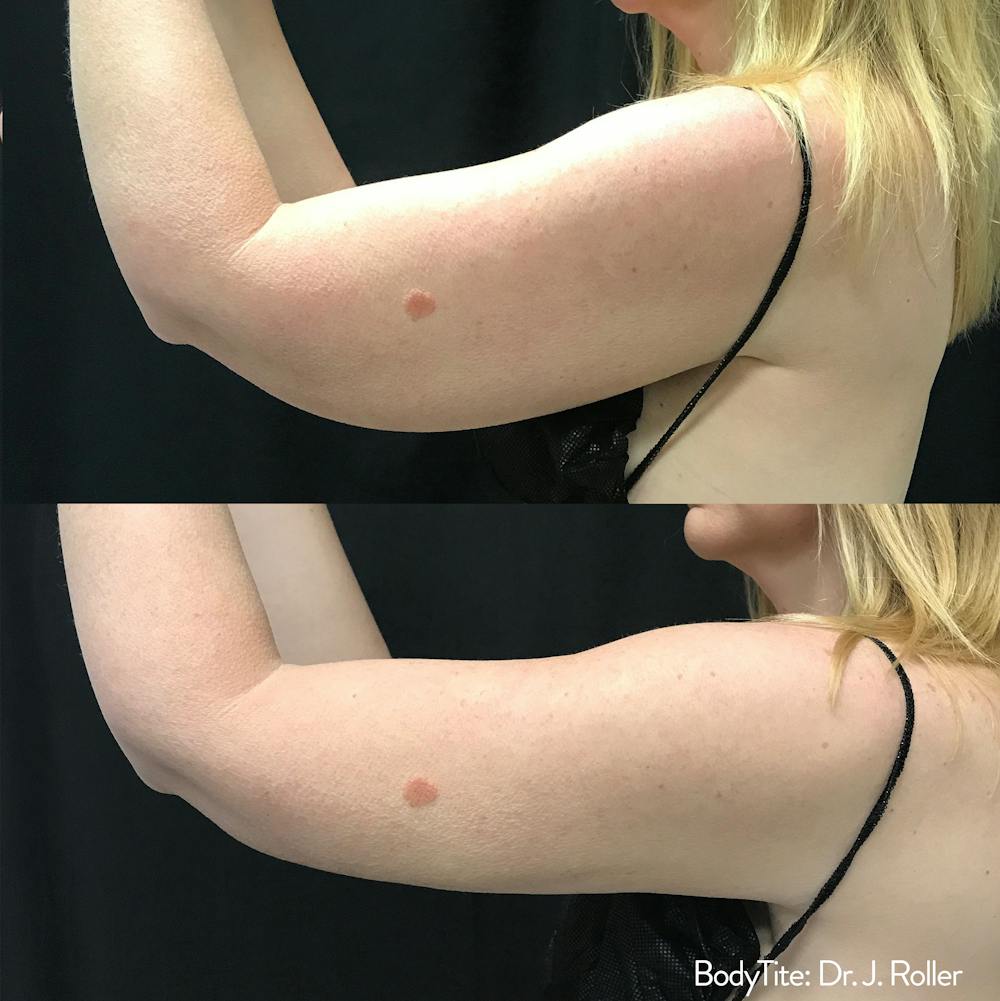 BodyTite Before & After Gallery - Patient 148257647 - Image 1