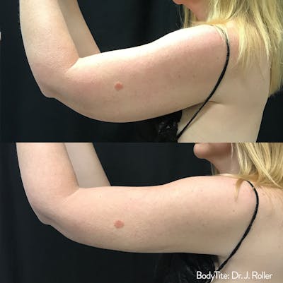 BodyTite Before & After Gallery - Patient 148257647 - Image 1