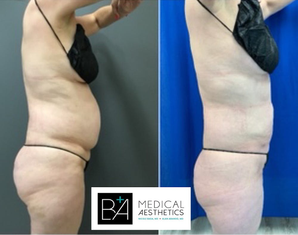 BodyTite Before & After Gallery - Patient 148257646 - Image 1