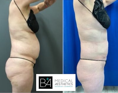 BodyTite Before & After Gallery - Patient 148257646 - Image 1