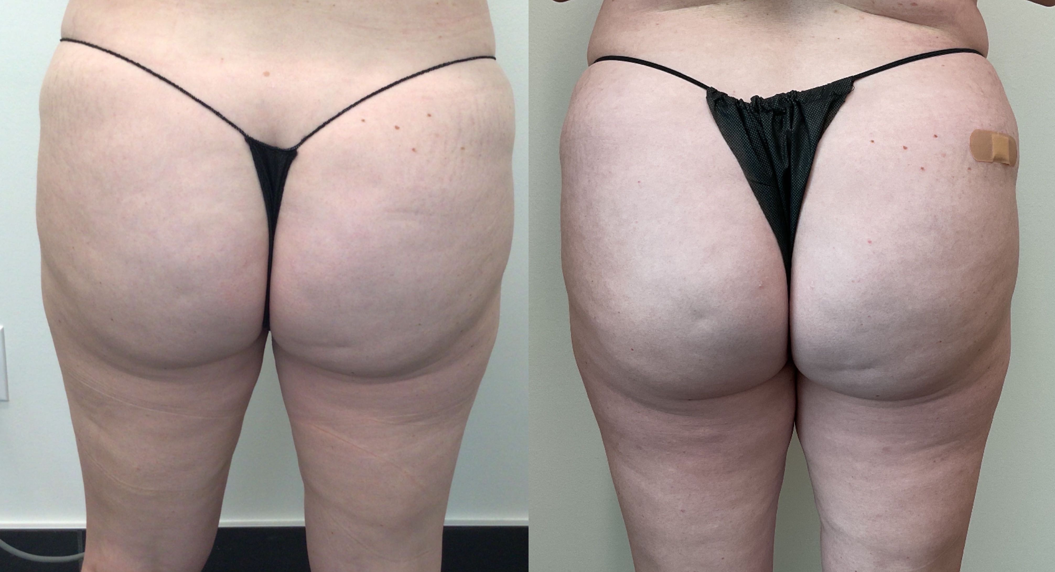 Emsculpt