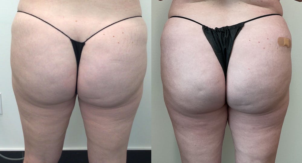 EMSCULPT Before & After Gallery - Patient 148257653 - Image 1