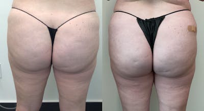 EMSCULPT Before & After Gallery - Patient 148257653 - Image 1