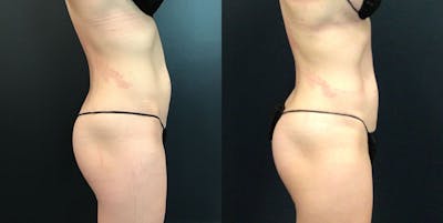 EMSCULPT Before & After Gallery - Patient 148257652 - Image 1