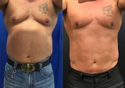 EMSCULPT Before & After Gallery - Patient 148257651 - Image 1