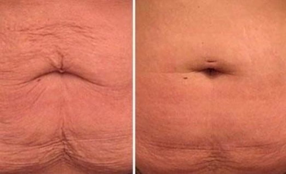 Morpheus 8 Skin Resurfacing Before & After Gallery - Patient 148257657 - Image 1