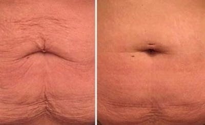 Morpheus 8 Skin Resurfacing Before & After Gallery - Patient 148257657 - Image 1