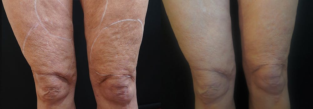 Morpheus 8 Skin Resurfacing Before & After Gallery - Patient 148257658 - Image 1
