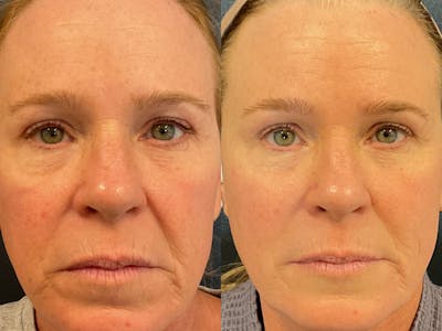 Morpheus 8 Skin Resurfacing Before & After Gallery - Patient 148257659 - Image 1