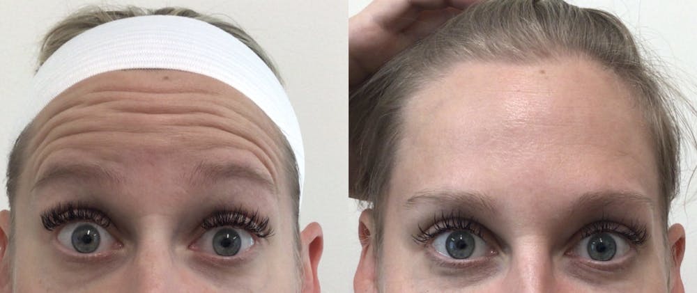Neurotoxin Before & After Gallery - Patient 148257669 - Image 1