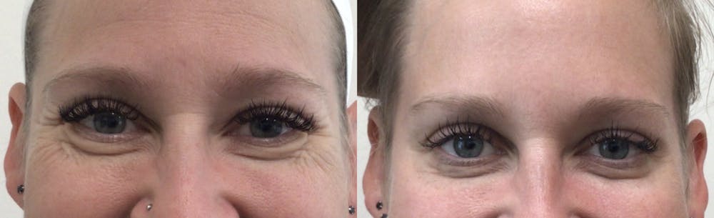 Neurotoxin Before & After Gallery - Patient 148257669 - Image 2
