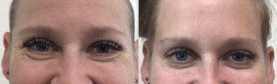 Neurotoxin Before & After Gallery - Patient 148257669 - Image 2