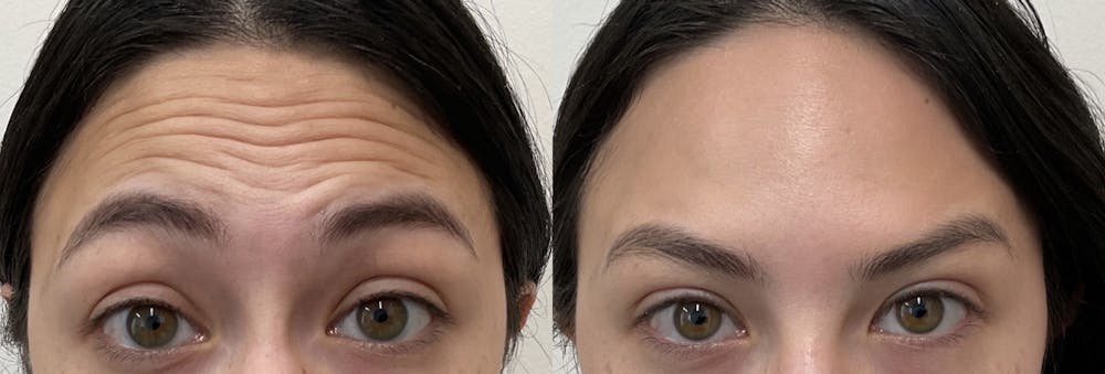Neurotoxin Before & After Gallery - Patient 148257670 - Image 1