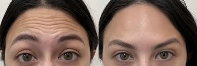 Neurotoxin Before & After Gallery - Patient 148257670 - Image 1