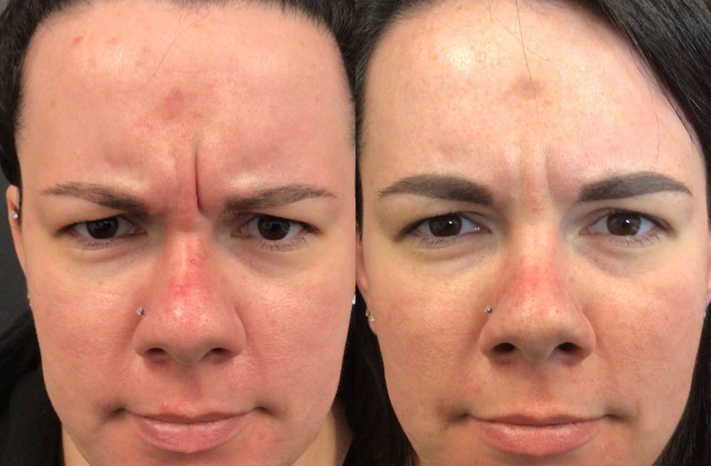 Neurotoxin Before & After Gallery - Patient 148257671 - Image 1