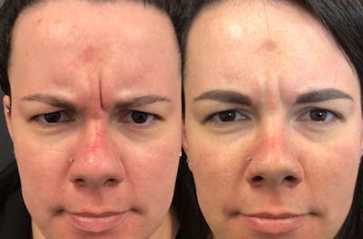 Neurotoxin Before & After Gallery - Patient 148257671 - Image 1