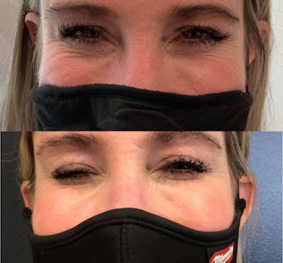 Neurotoxin Before & After Gallery - Patient 148257672 - Image 1