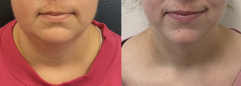 Evoke Before & After Gallery - Patient 148257674 - Image 1