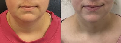Evoke Before & After Gallery - Patient 148257674 - Image 1