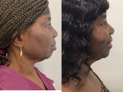 Evoke Before & After Gallery - Patient 148257675 - Image 1