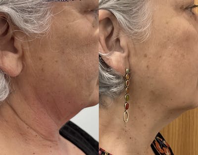 FormaPlus Before & After Gallery - Patient 148257712 - Image 1