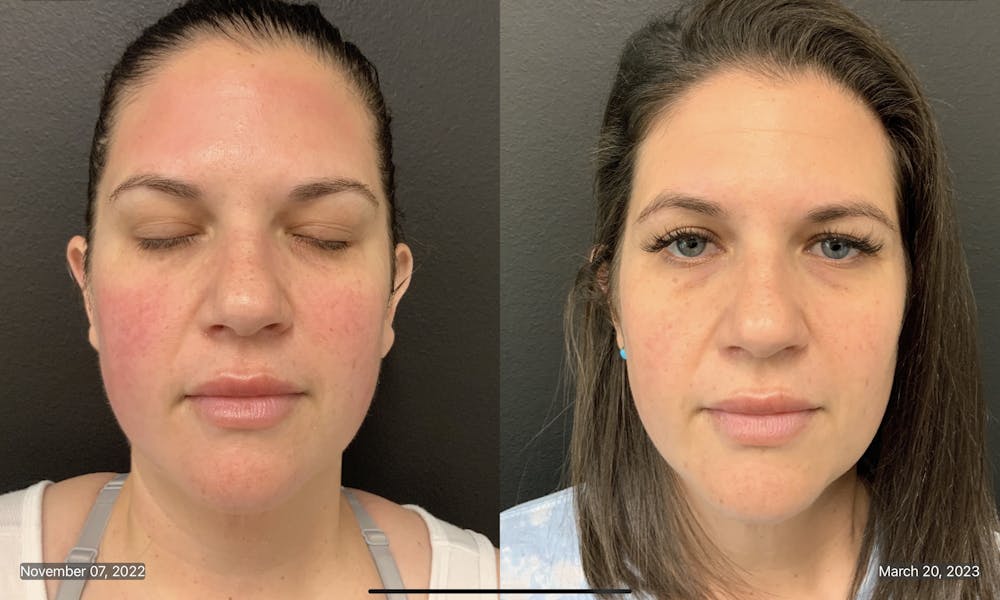 FormaPlus Before & After Gallery - Patient 148257713 - Image 1