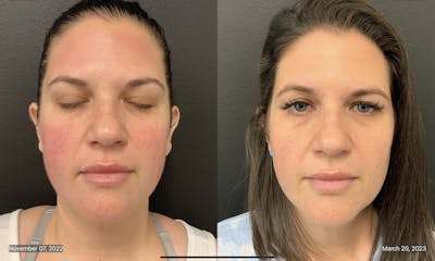 FormaPlus Before & After Gallery - Patient 148257713 - Image 1