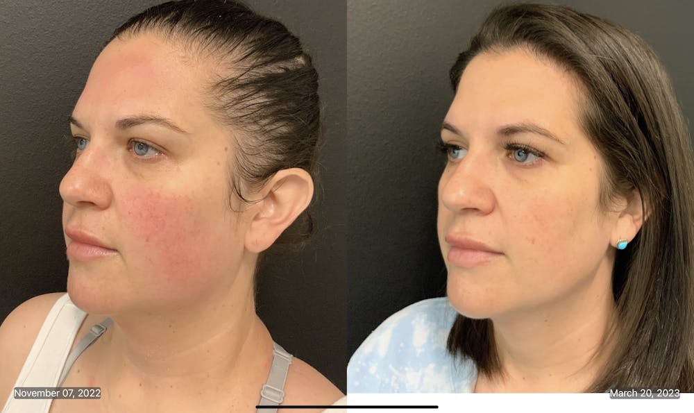 FormaPlus Before & After Gallery - Patient 148257713 - Image 2