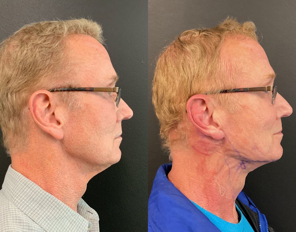 MyEllevate Before & After Gallery - Patient 148257751 - Image 1