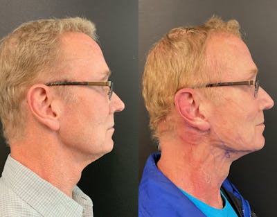 MyEllevate Before & After Gallery - Patient 148257751 - Image 1