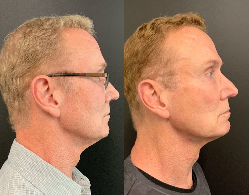MyEllevate Before & After Gallery - Patient 148257751 - Image 2