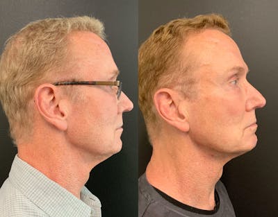 MyEllevate Before & After Gallery - Patient 148257751 - Image 2