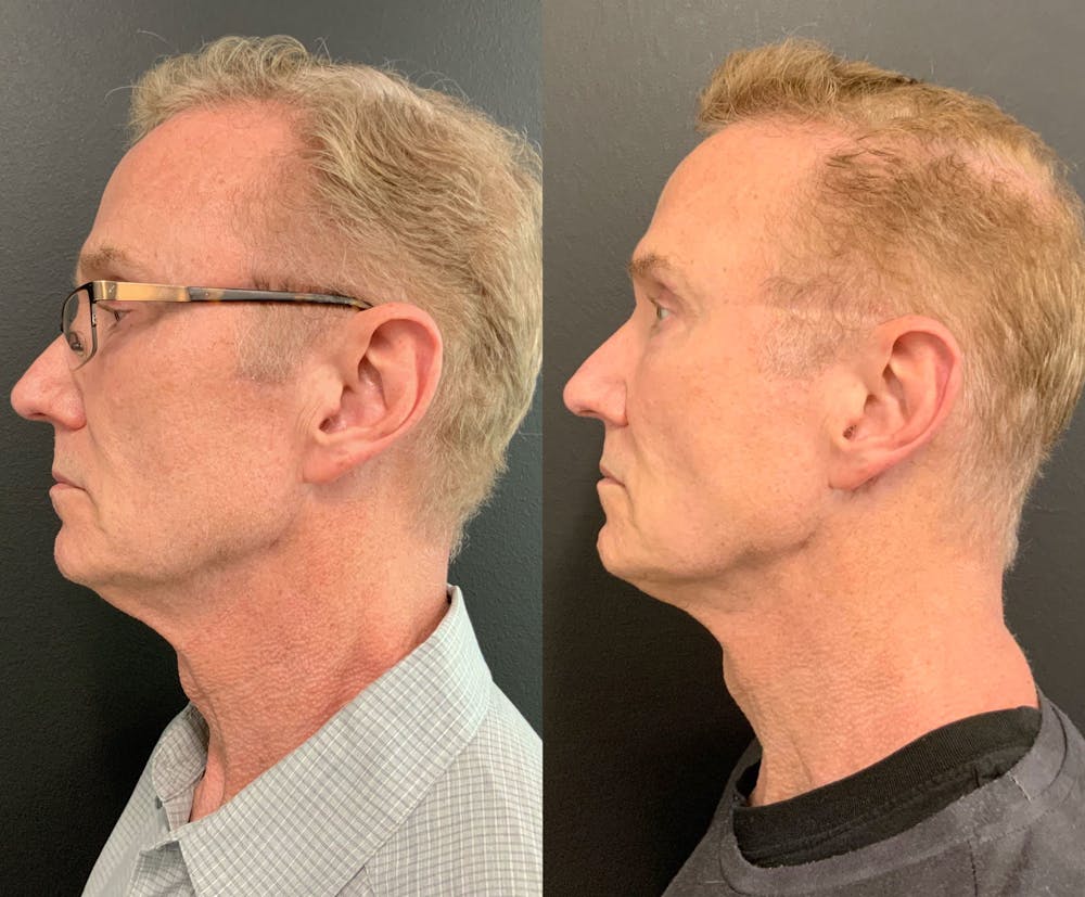 MyEllevate Before & After Gallery - Patient 148257751 - Image 3