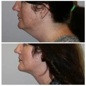 before and after of patients neck after FaceTite