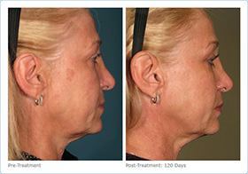 side profile before and after of patient after Ultherapy