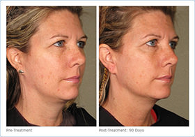 side profile before and after of patient after Ultherapy 2