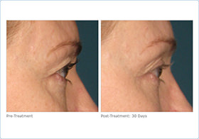 close up before and after of patients eyes after Ultherapy