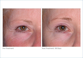  before and after of patients eyes after Ultherapy